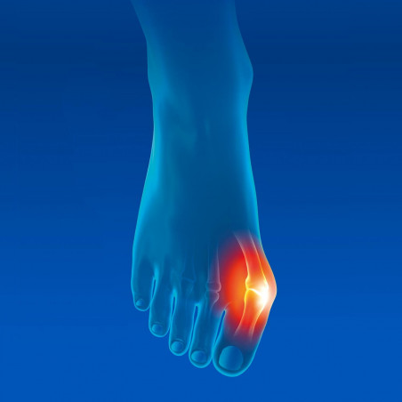 oignon-orteil-hallux-valgus-tous-ergo