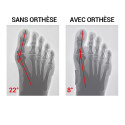 Orthèse corrective Hallux Valgus souple Jour Epitact