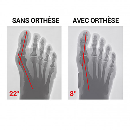 Orthèse corrective Hallux Valgus souple Jour Epitact