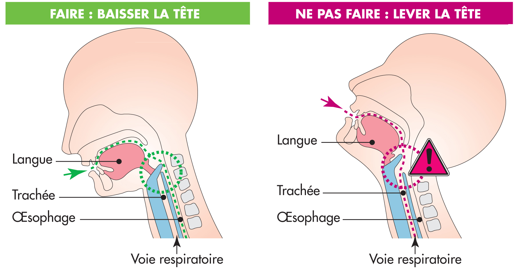 Dysphagie : Comment éviter une fausse route ? - Blog Tous ergo