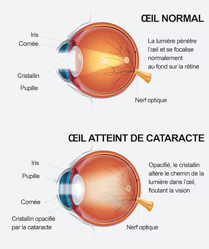 Baisse de la vue : causes et solutions !