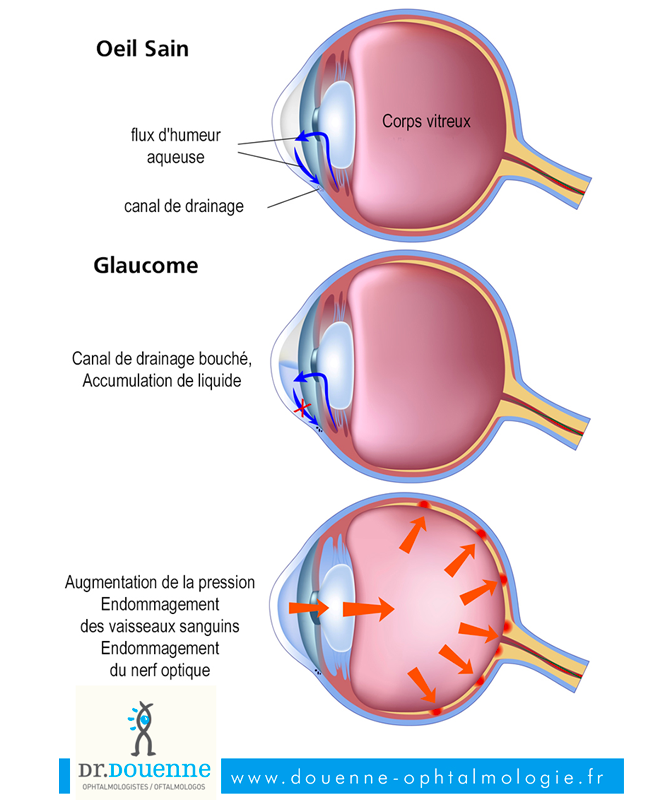 Baisse de la vue : causes et solutions !